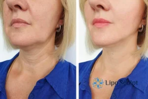 Double chin before and after Hi-Fu treatment 4 Book your double chin treatment Crawley Down today! We are here to help!