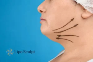 Double chin before and after Hi-Fu treatment 3 Boost your confidence with a Double chin treatment Crawley Down