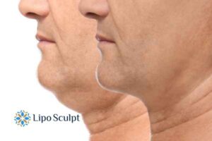 Double chin before and after Hi-Fu treatment 2 Double chin treatment Crawley Down from Lipo Sculpt - feel more confident today!