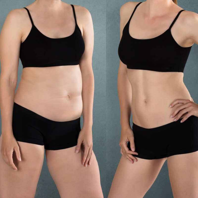 Does Fat Freezing at Home Work? DIY Devices vs Professional Cryolipolysis 2 before and after Cryolipolysis Crawley Down