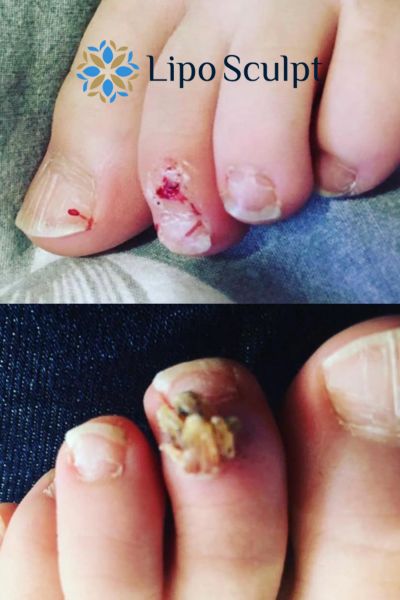 Wart removal customer results from Lipo Sculpt Crawley Down