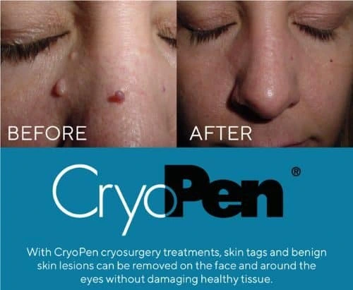 image of angiofibroma removal Crawley Down using Lipo Sculpt cryopen!